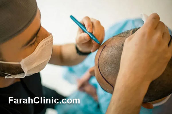 بهترین روش کاشت مو در غرب تهران | فرح کلینیک