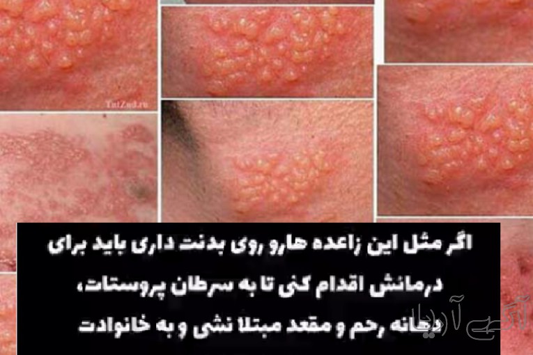 اسپری کرایو درمان زگیل تناسلی در منزل