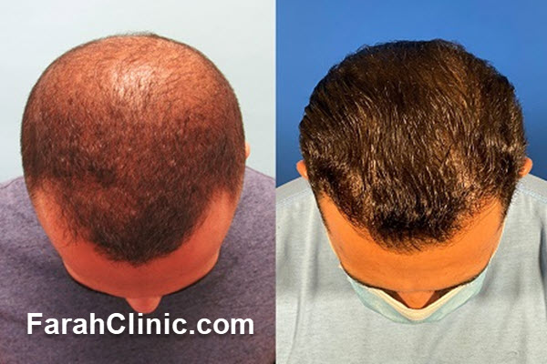 بهترین روش کاشت مو در سعادت آباد