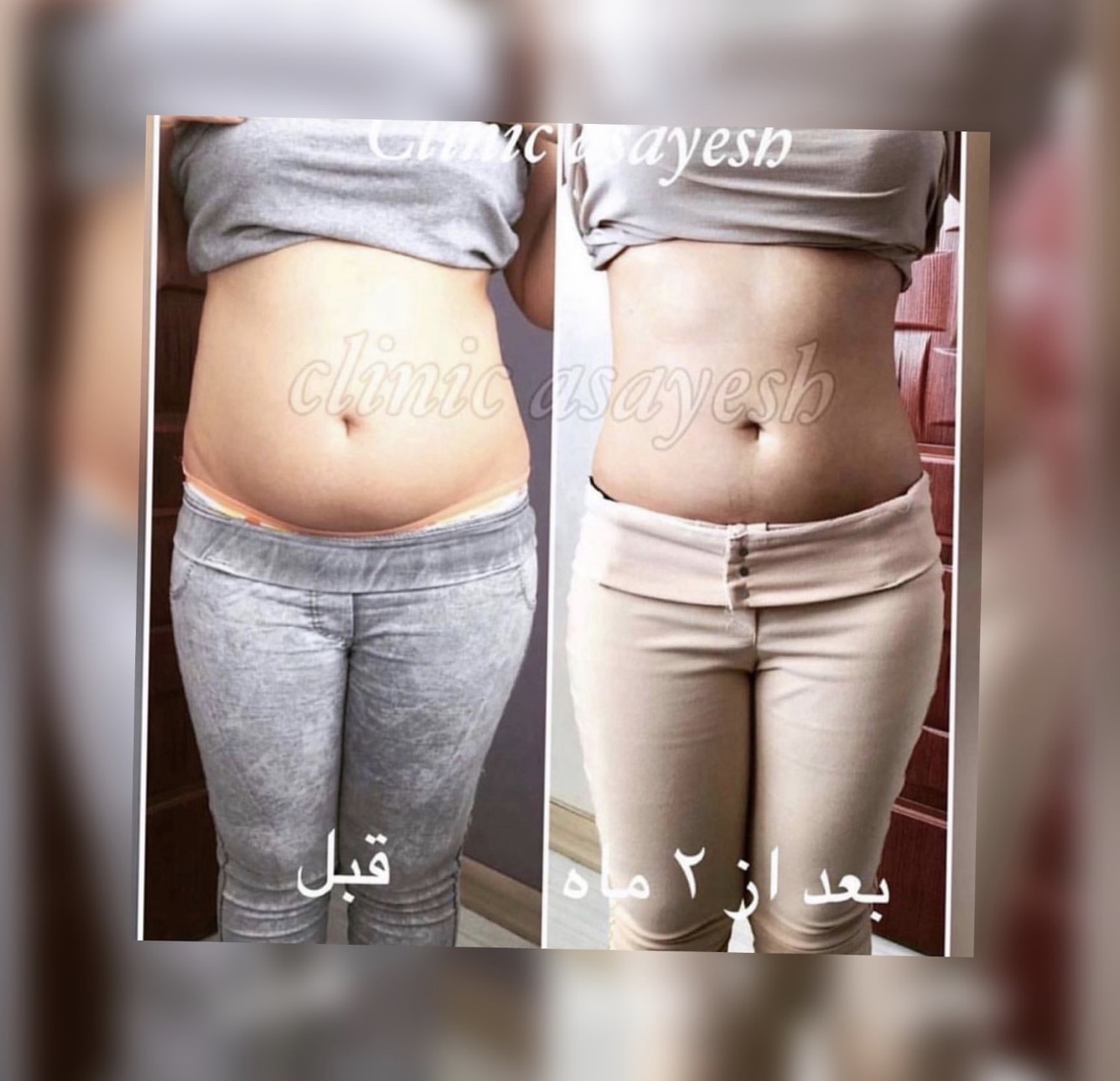 لاغری بدون جراحی با کرایولیپولیز
