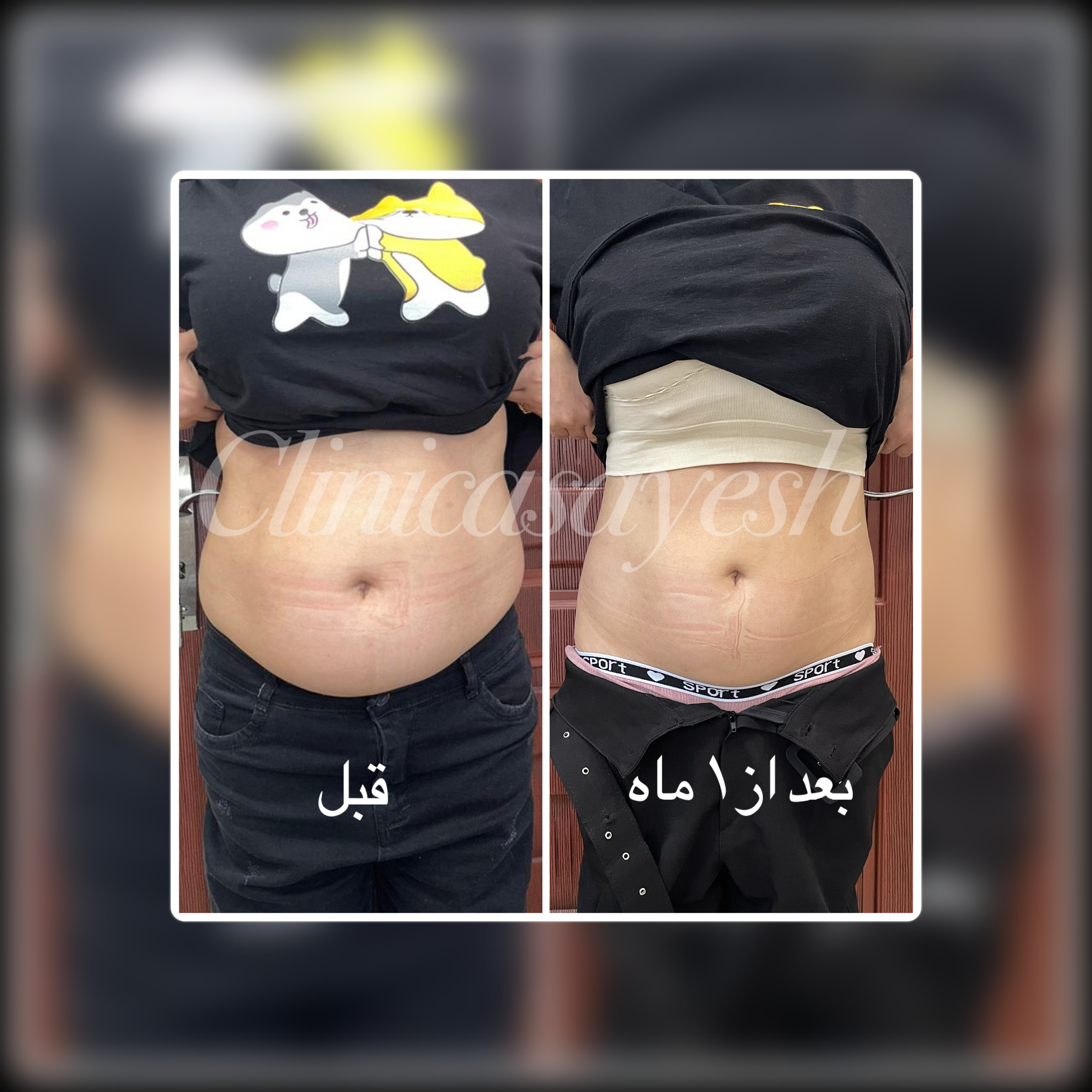 لاغری با کرایولیپولیز